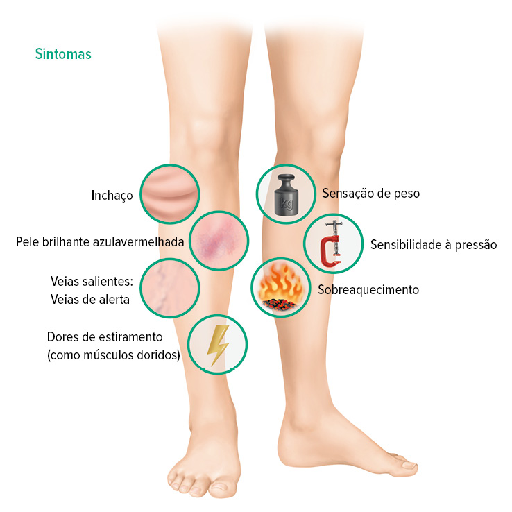 Sintomas da trombose venosa profunda Sintomas da trombose venosa profunda