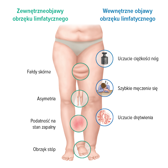 Objawy obrzęku limfatycznego Objawy obrzęku limfatycznego