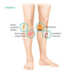 Symptômes thrombose veineuse superficielle
