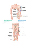 The symptoms of lymphoedema
