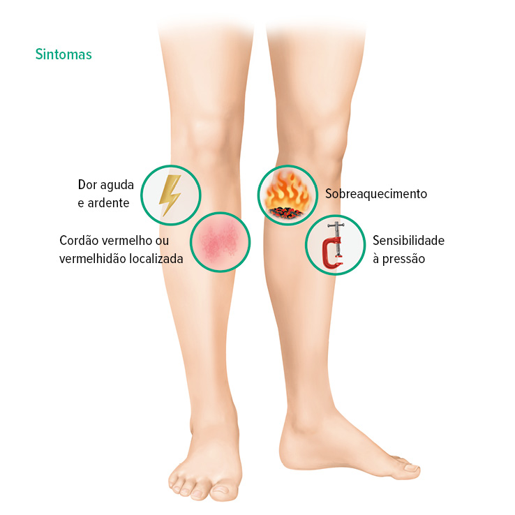 Sintomas da trombose venosa superficial Sintomas da trombose venosa superficial
