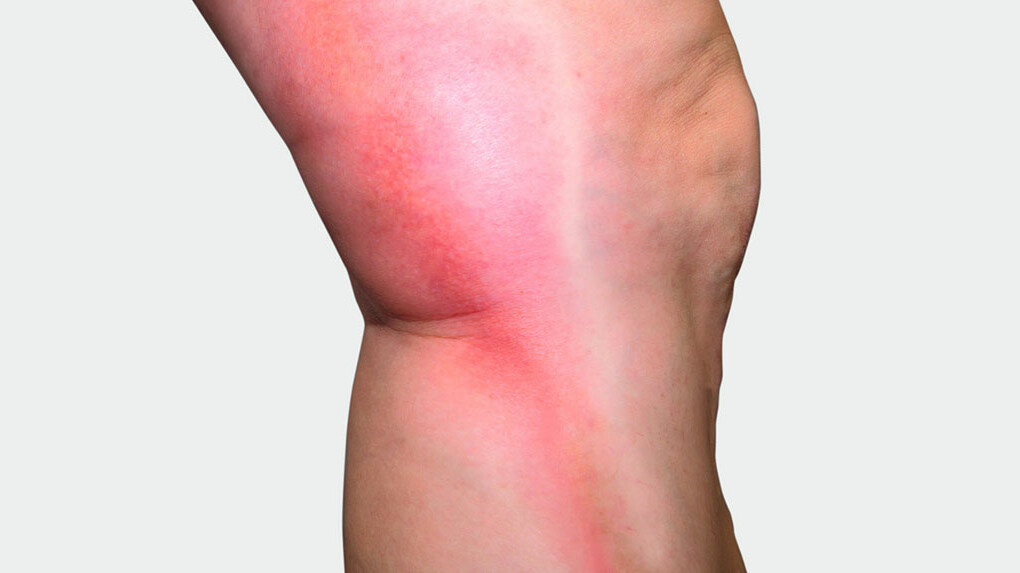 Mainteaser Thrombose Beine mit rotem Strang auf der Seite