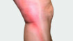 Beine mit rotem Strang auf der Seite