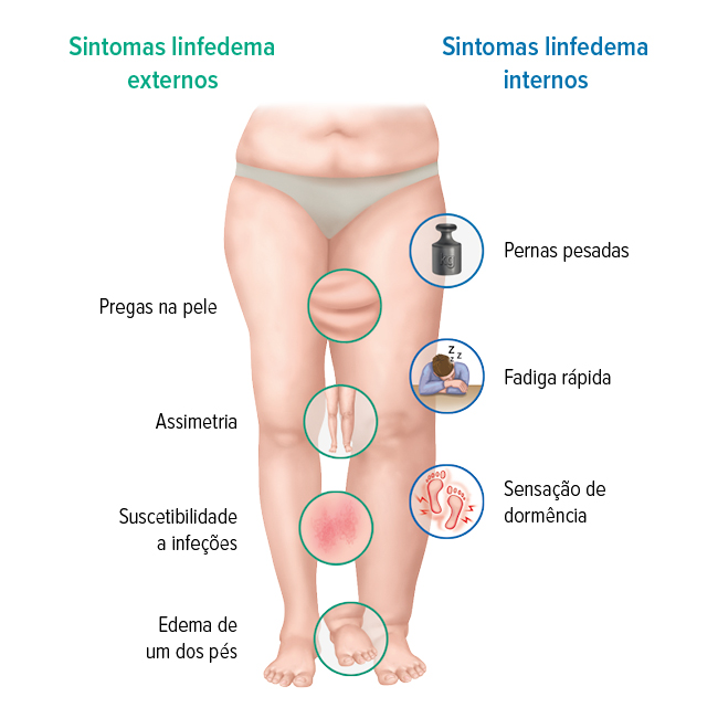 Os sintomas de linfedema