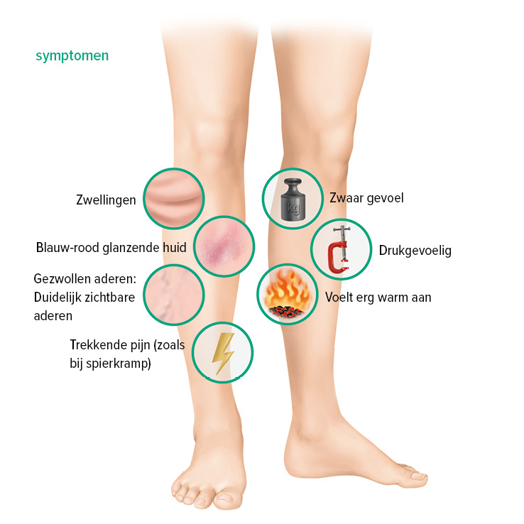 Symptomen diep veneuze trombose Symptomen diep veneuze trombose