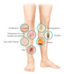Symptômes d'un ulcère de jambe