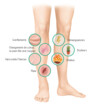 Symptômes d’un ulcère de la jambe