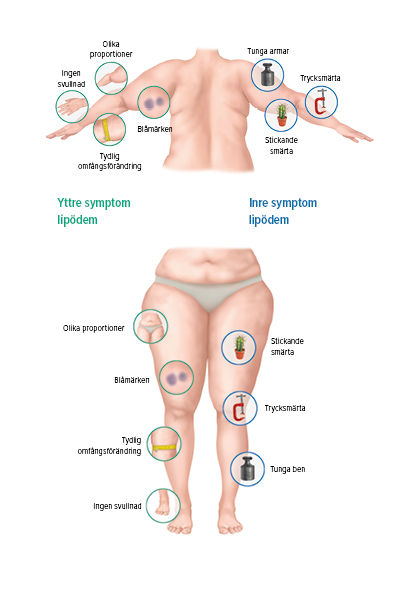 Leva med lipödem