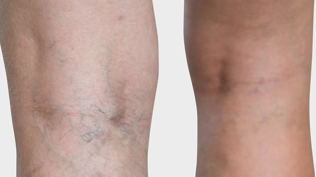 Conhecimento: Telangiectasia (vasinhos) Conhecimento: Telangiectasia (vasinhos)