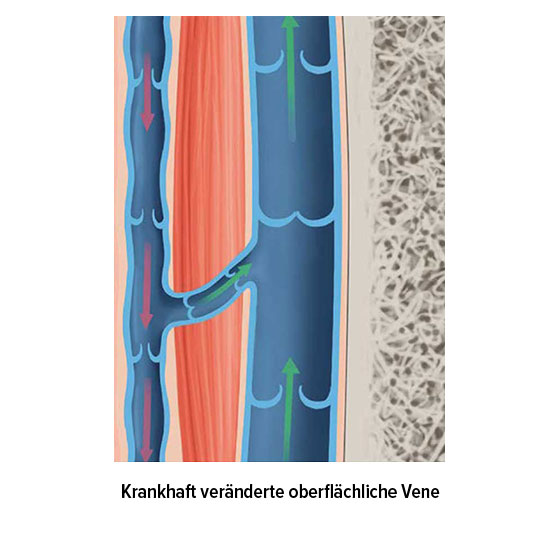 Krankhaft veränderte oberflächliche Vene
