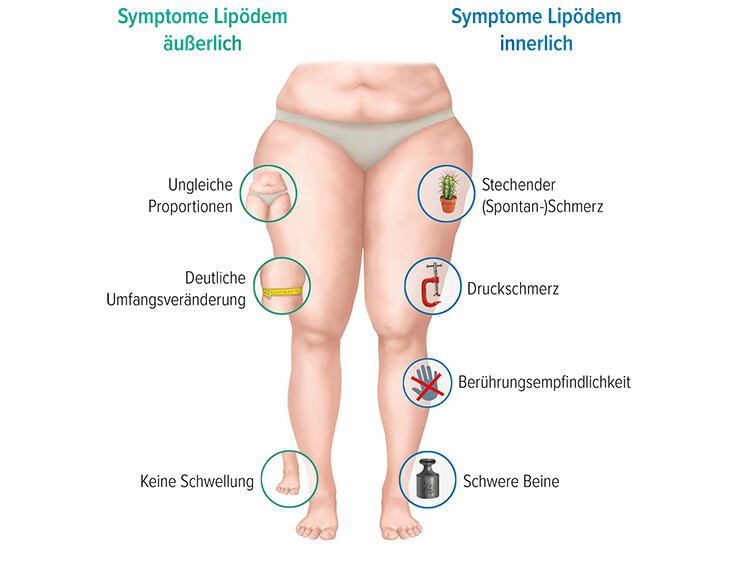 Lipödem Symptome Lipödem Symptome