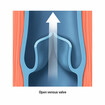 Open venous valve