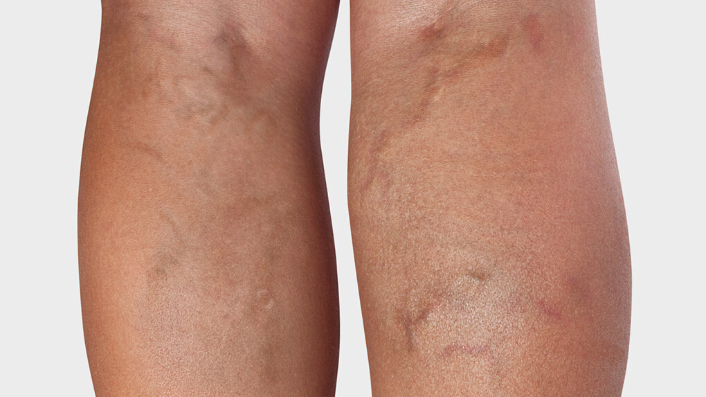 Varicose veins Legs with varicose veins