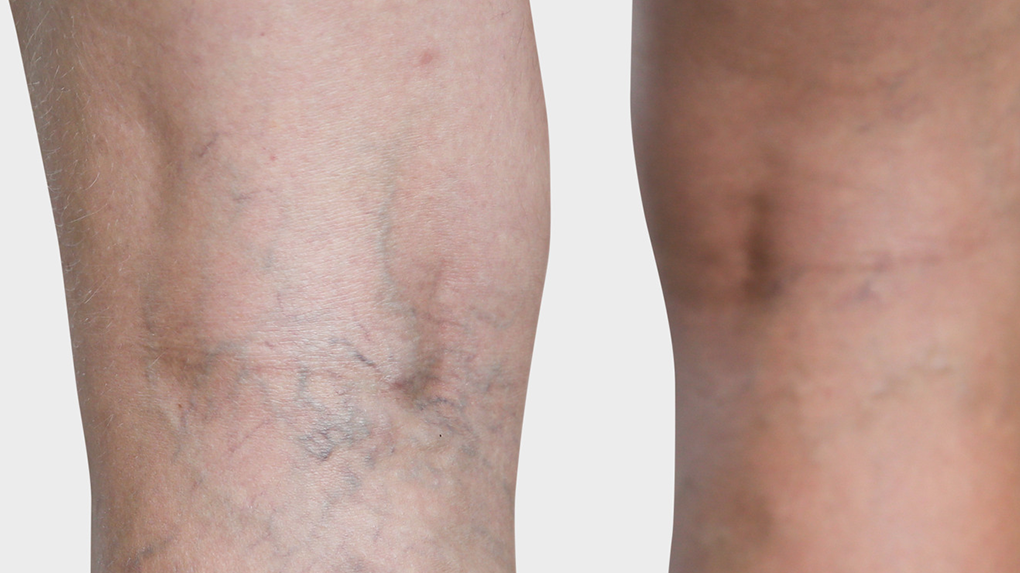 spider veins Legs with spider veins