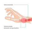 Auf dieser Grafik erkennt man die Anatomie einer Hand, die Sehnen verlaufen durch Sehnenscheiden in der Hand
