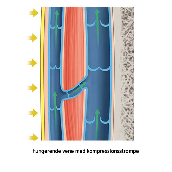 Fungerende vene med kompressionsstrømpe