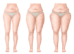 El gráfico muestra los estadios del lipedema