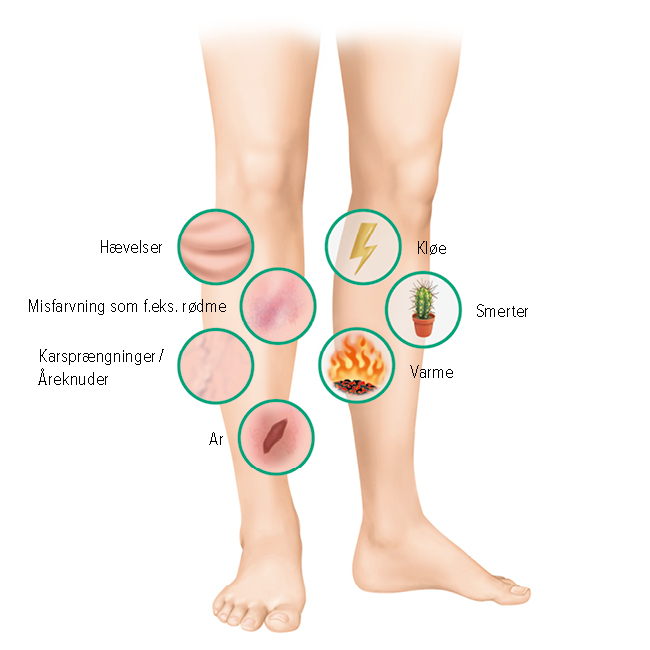 Symptomer på bensår