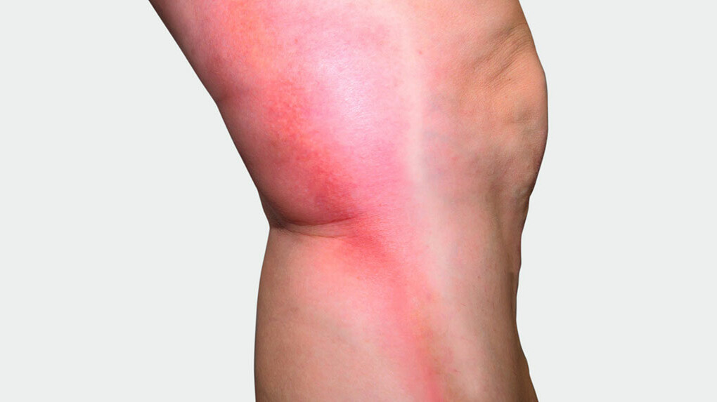 Thrombosis Legs with thrombosis