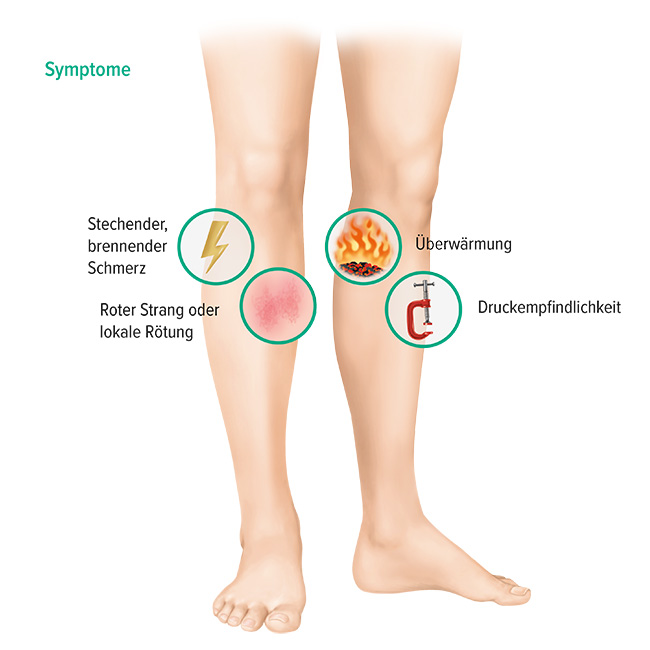 Symptome oberflächliche Venenthrombose Symptome oberflächliche Venenthrombose