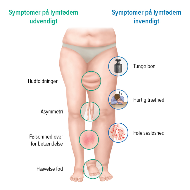 Symptomerne på et lymfødem Symptomerne på et lymfødem