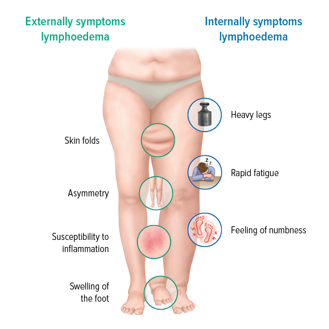The symptoms of lymphoedema The symptoms of lymphoedema