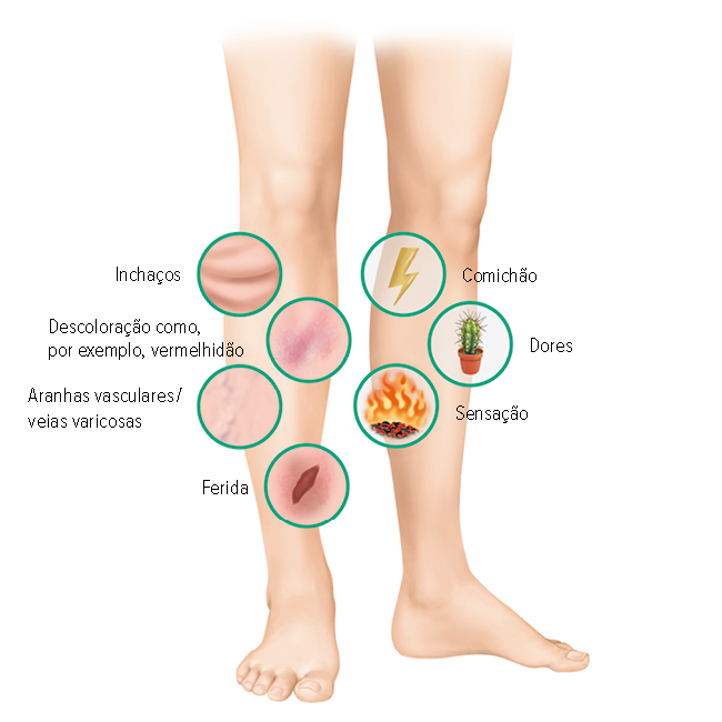Sintomas da úlcera varicosa