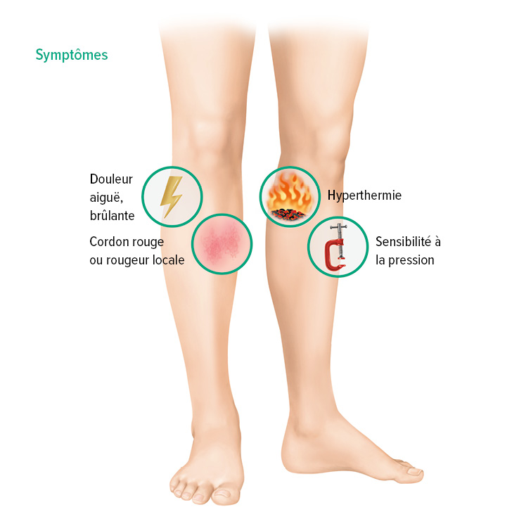 Symptômes de la thrombose veineuse superficielle Symptômes de la thrombose veineuse superficielle