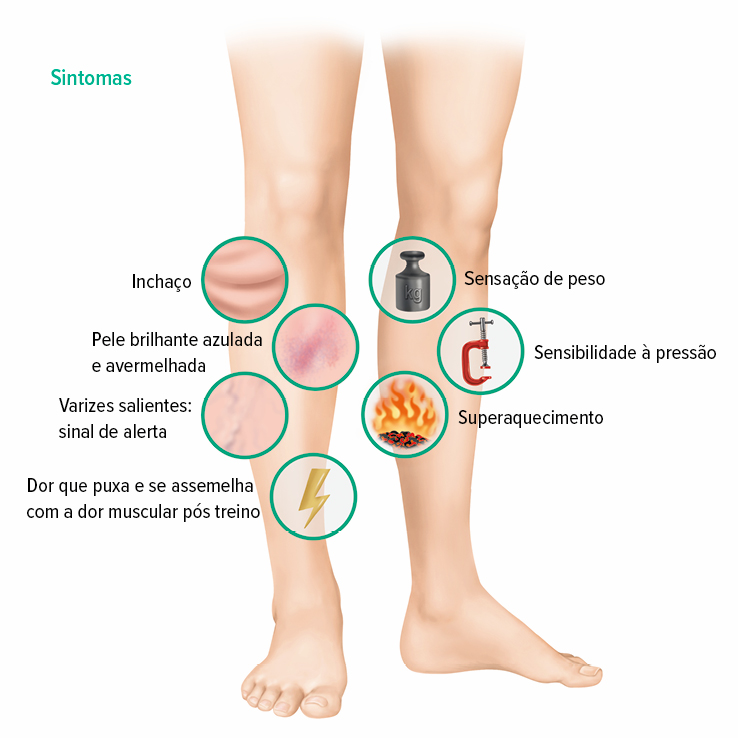 Sintomas de trombose venosa profunda (TVP)  Sintomas de trombose venosa profunda (TVP)